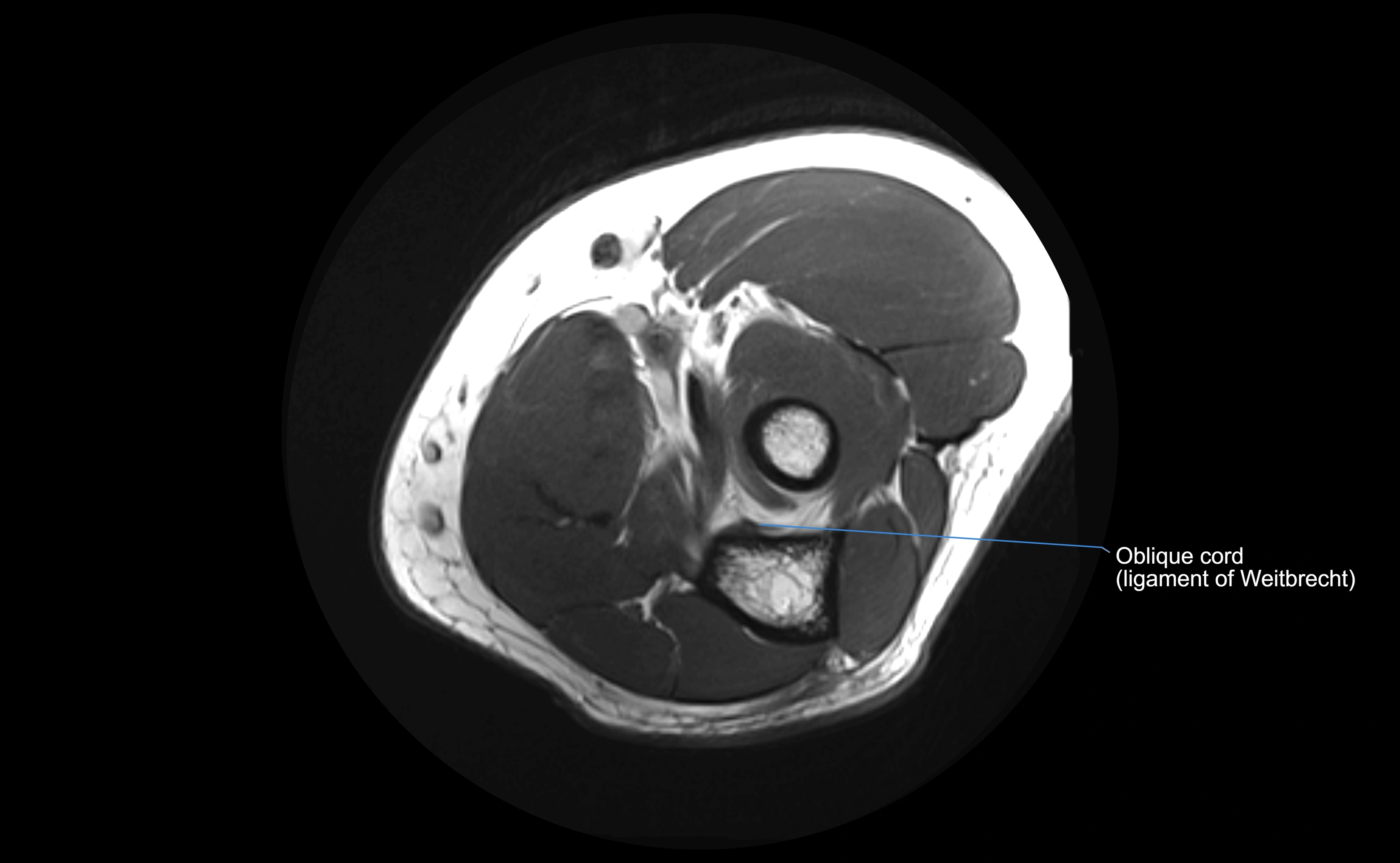 MRI elbow ligaments axial cross sectional anatomy 3T  radiology  image-img-00001-00021.webp